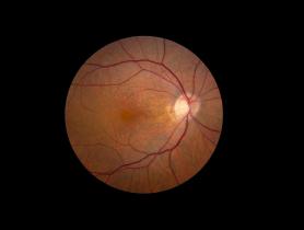 Fundus photo shows giraffe like macular pattern in the retina of a person with reticular pseudodrusen